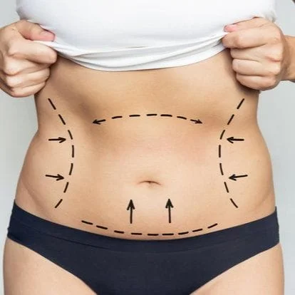 ​Who is a Good Candidate for Liposuction?