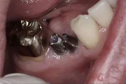 Dental Implants