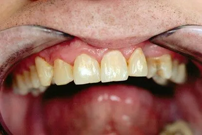 Anterior Veneers and Crowns