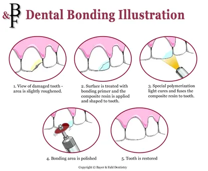 Dental Bonding Illustration
