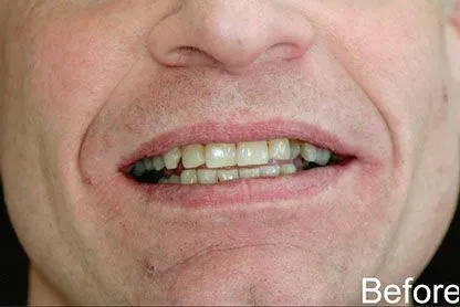 Anterior Veneers and Crowns