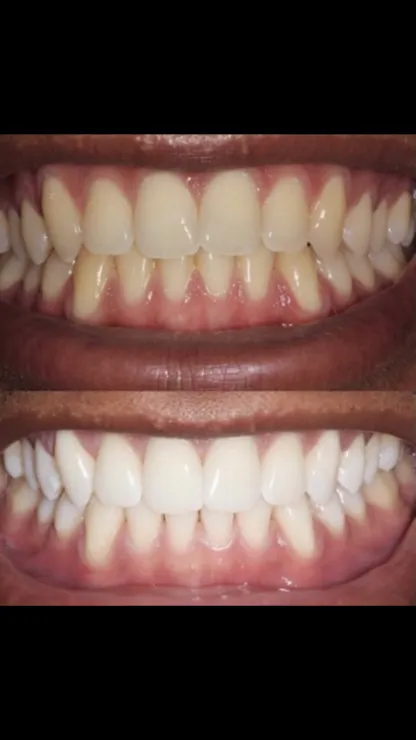 teethWhitening