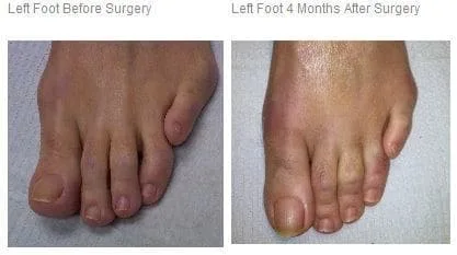 Left Foot Before & After Surgery