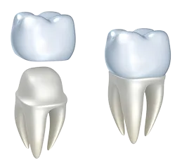 illustration of dental crown being placed over prepared tooth, dental crowns Newark, CA dentist