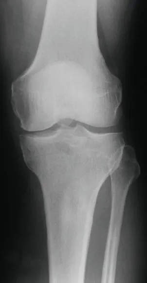 Osteoarthritis