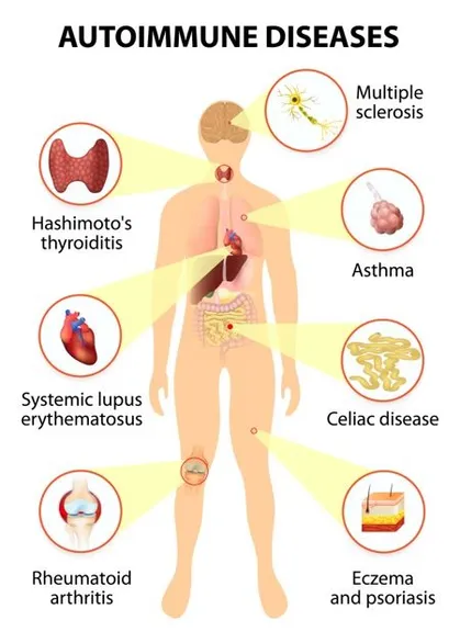 Inflammation and autoimmune diseases