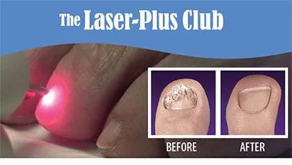 Laser-Plus Club for Treatment of Toenail Fungus