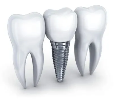 Implant Photo