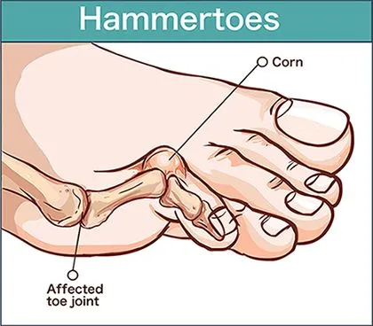 Hammertoe-Surgery-in-Austin-TX