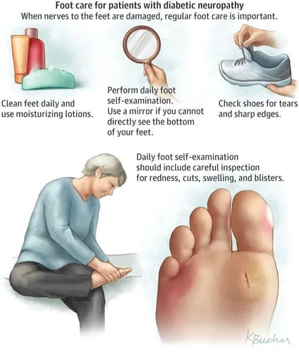 Monofilament testing in diabetic foot – Primary Care Notebook