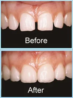 Veneers | Dentist in Saluda, SC | Saluda Smilemakers