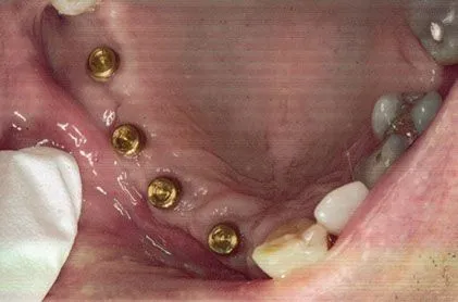 Implants with Partial Plate