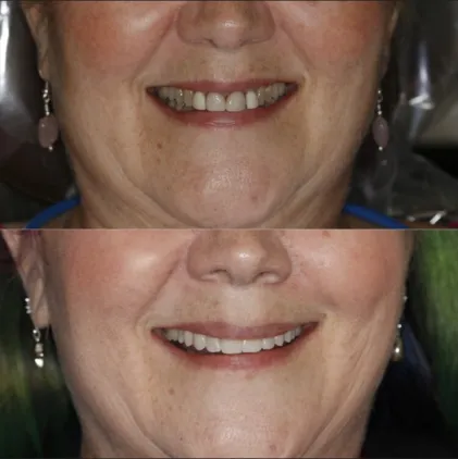Before and after of woman's teeth with dental veneers brookline, MA
