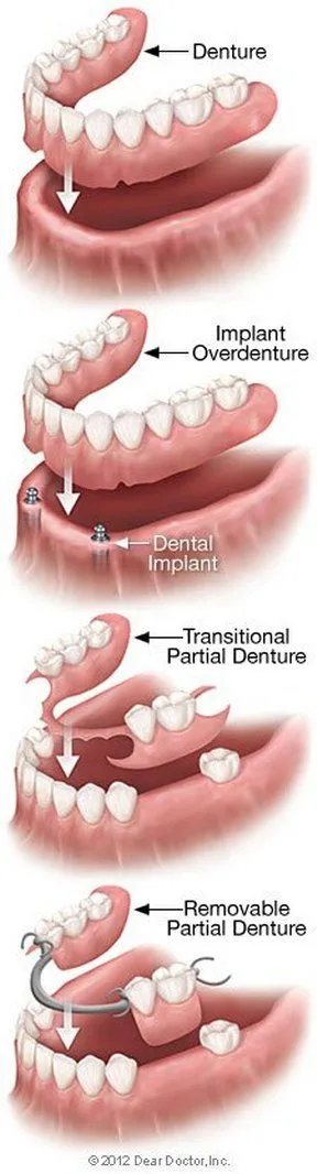 types of dentures Amelia, OH