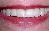 beautiful_veneers_aft.jpg