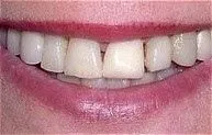 beautiful_veneers_bef.jpg