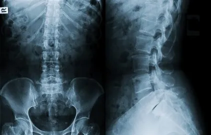 x-ray of spine