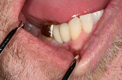 Case #1 Dental Implants