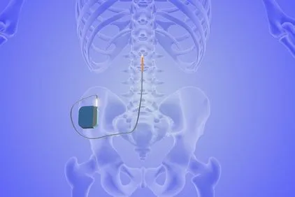 Spinal Cord Stimulation