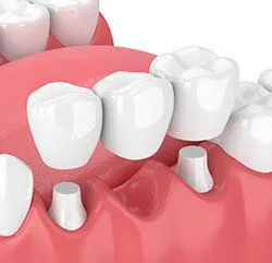 illustration of dental bridge being placed over abutment teeth, dental bridge Spokane, WA dentist 