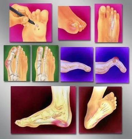 La Mesa Podiatrist | La Mesa | CA | JERRY M. FABRIKANT D.P.M. F.A.C.F.A.S |