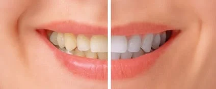teeth whitening in Wichita, KS