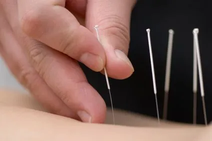 dry-needling