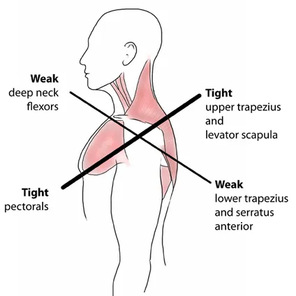 upper crossed syndrome