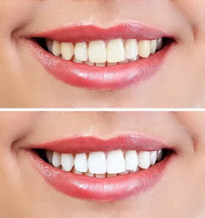 teeth whitening for life