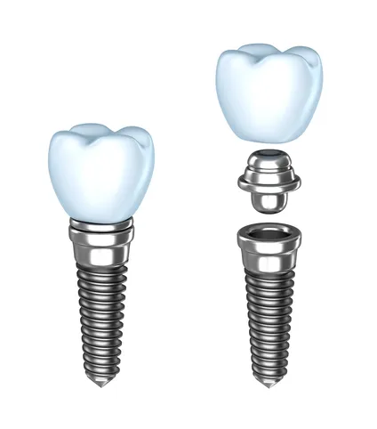 illustration of assembly parts of Dental Implants Manteca, CA