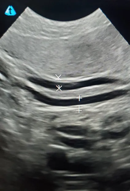 ultrasound