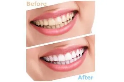 teeth whitening