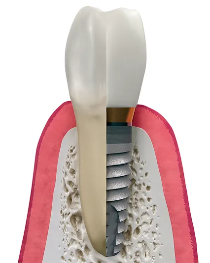 Comparing tooth to implant