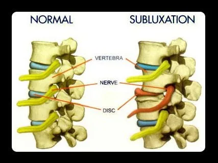 subluxation complex
