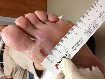 Diabetic Wound Before Dermagraft