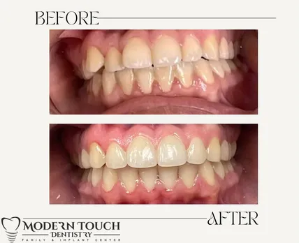 Invisalign