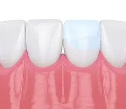 illustration of dental bonding on tooth repairing crack, dentist Spokane, WA cosmetic dentistry