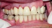 after cosmetic dentistry