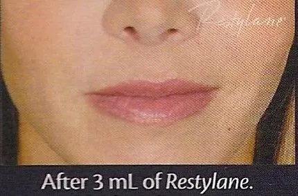 After Restylane® Nasolabial Folds