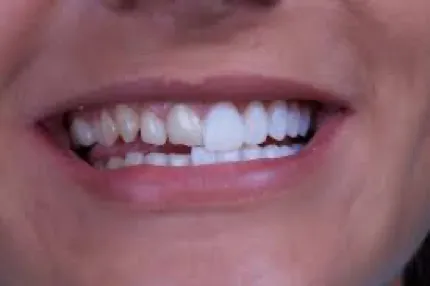 Veneers in Bethesda