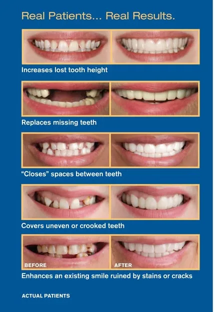 What is Snap-On Smile?