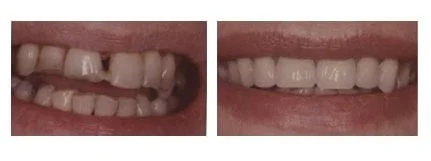 Dentures - Before & After
