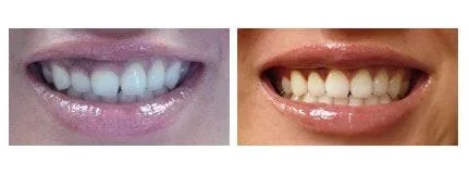 Gum Surgery with Laser - Before & After
