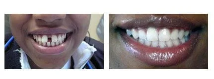 Invisalign - Before & After