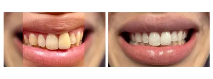 Crowns - Before & After