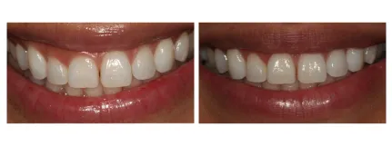 Gingivectomy - Before & After
