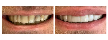 Crowns - Before & After