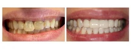 Temporary Crowns - Before & After