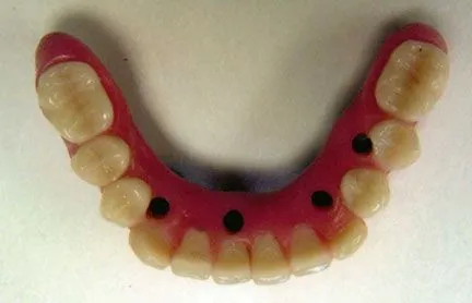 Dental Implants with Screw Retained Denture