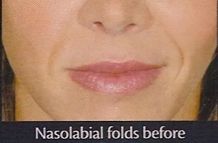 Before Restylane® Nasolabial Folds